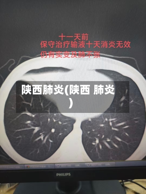 陕西肺炎(陕西 肺炎)-第2张图片